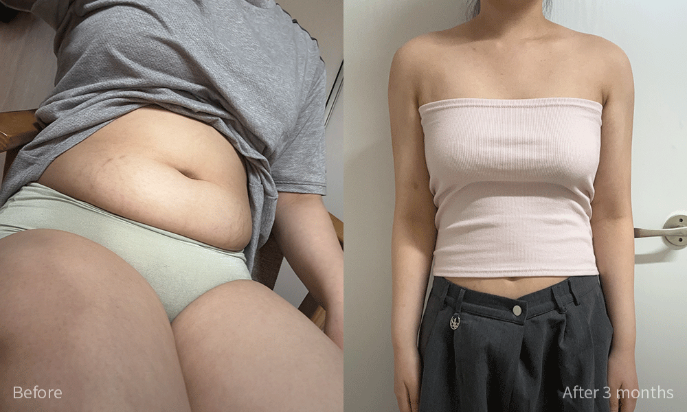 지방흡입 전후사진
