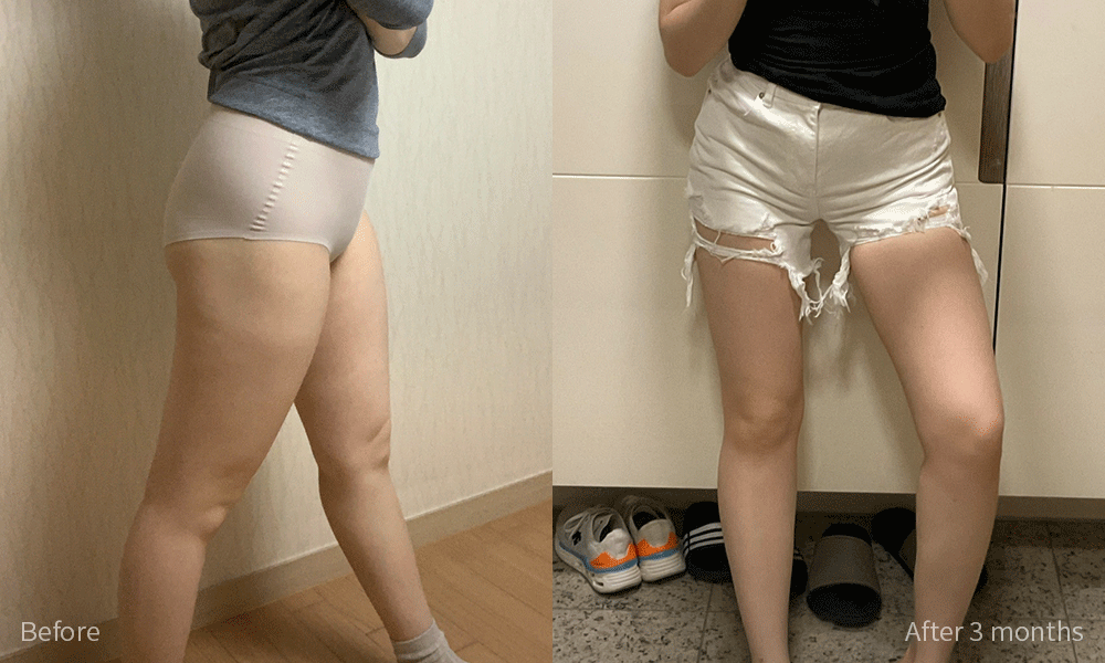 지방흡입 전후사진