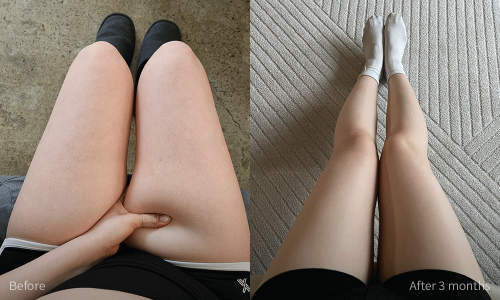 지방흡입 전후사진