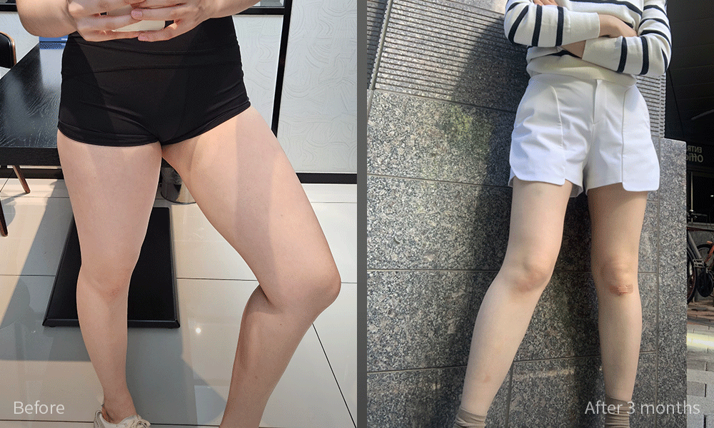 지방흡입 전후사진