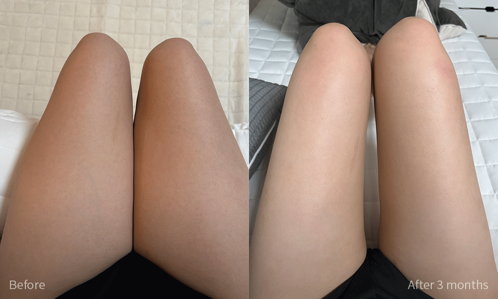 지방흡입 전후사진