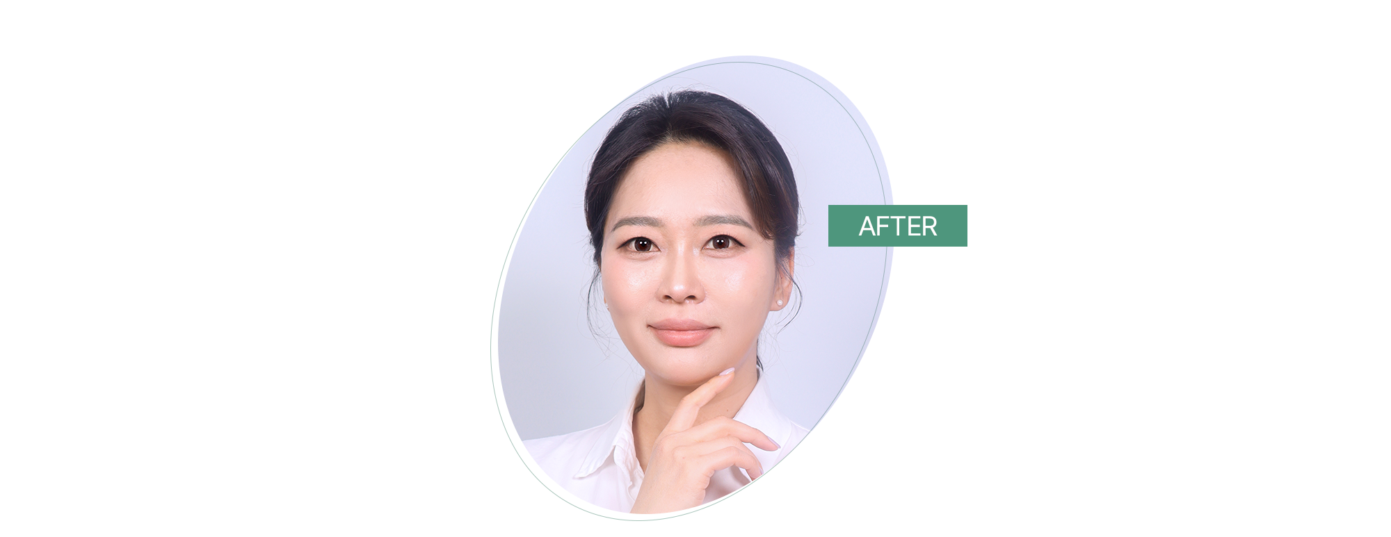 리프팅 전후사진