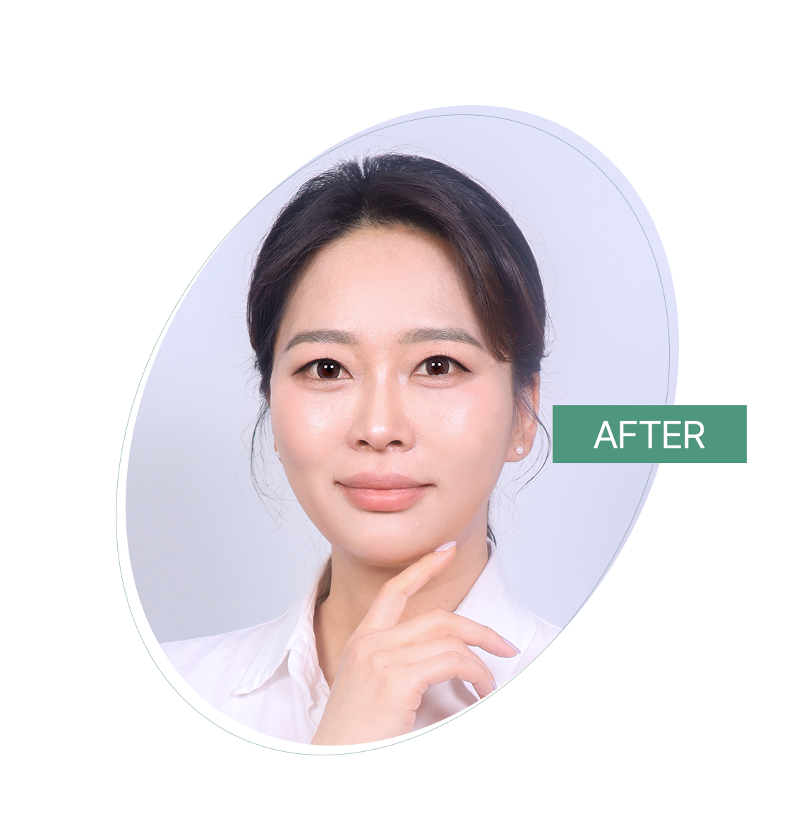 리프팅 전후사진