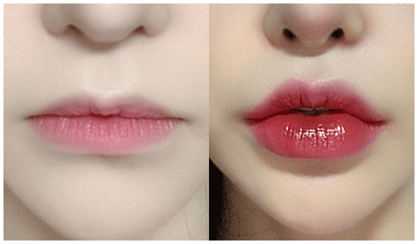 botox 전후사진