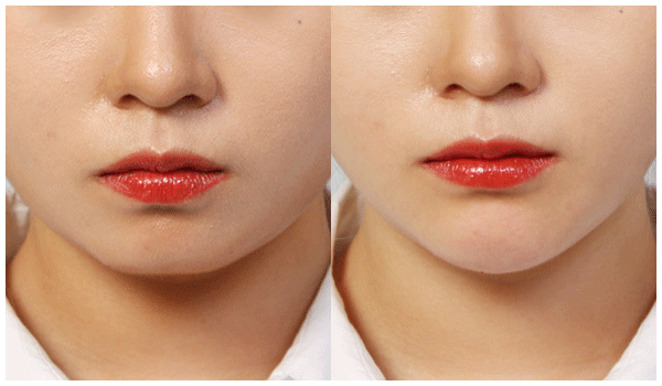 botox 전후사진