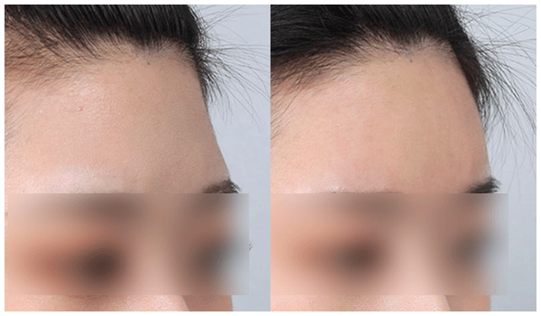 botox 전후사진